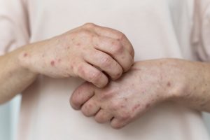 varíola dos macacos, monkeypox